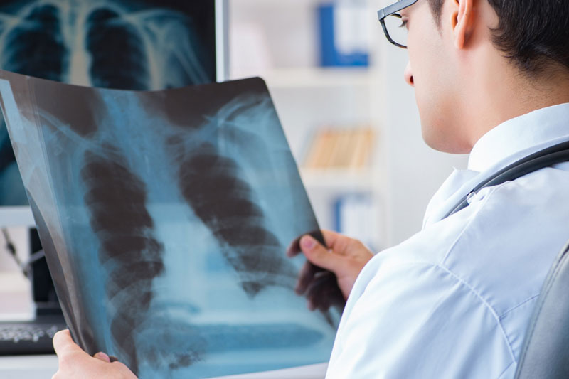 A lung specialist holds an image of a patient's lungs and inspects it for signs of disease.