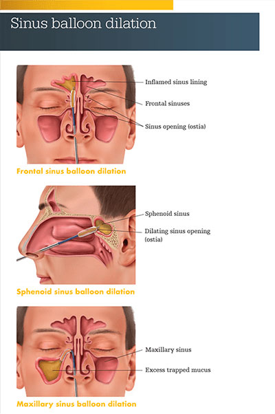 A graphic of the anatomy of the sinus.