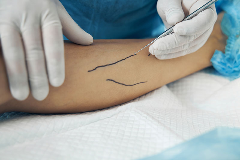 A vascular surgeon performs a procedure on a patient’s veins.