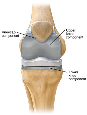 An illustration of a prosthetic knee joint