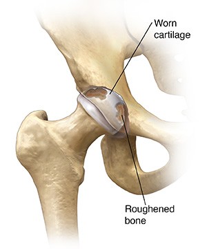 An illustration of a problem hip joint