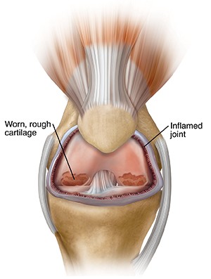 An illustration of a problem knee joint